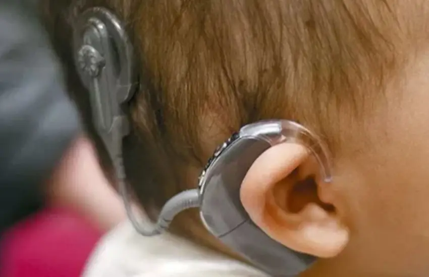 cochlear-implant